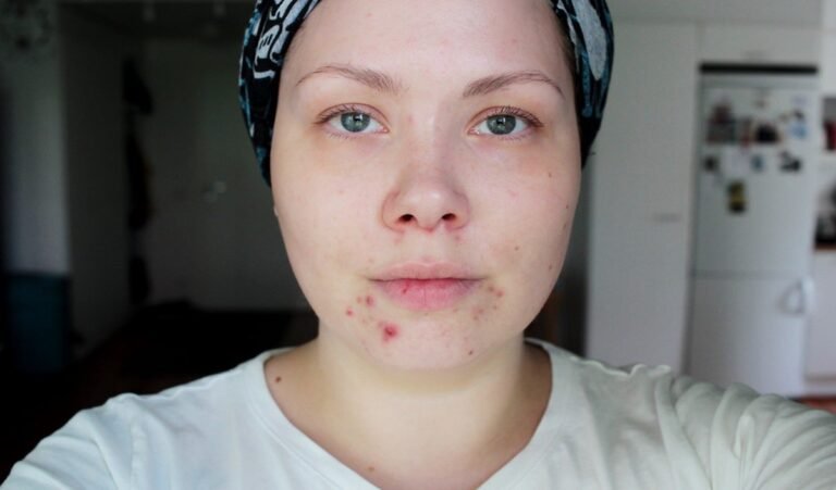 Hormonal Acne