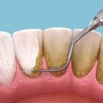 दांतों से जिद्दी पीले रंग की पट्टिका को हटाने के लिए संघर्ष? इन प्रभावी घरेलू उपचारों की कोशिश करें