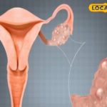 पीसीओडी