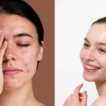 सक्रिय पिंपल्स को वश में करने और स्पष्ट त्वचा को प्राप्त करने के लिए तत्काल घरेलू उपचार का उपयोग कैसे करें