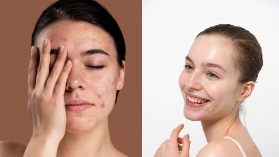 सक्रिय पिंपल्स को वश में करने और स्पष्ट त्वचा को प्राप्त करने के लिए तत्काल घरेलू उपचार का उपयोग कैसे करें