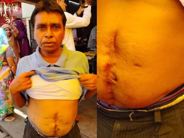जयपुर ब्लास्ट सर्वाइवर: बम के टुकड़े पेट और जांघ में 17 साल तक मौत के साथ फंस गए हैं