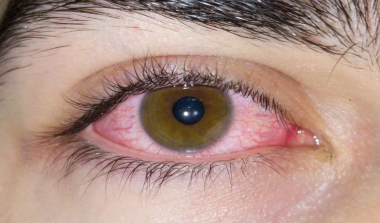 Common Eye Problems