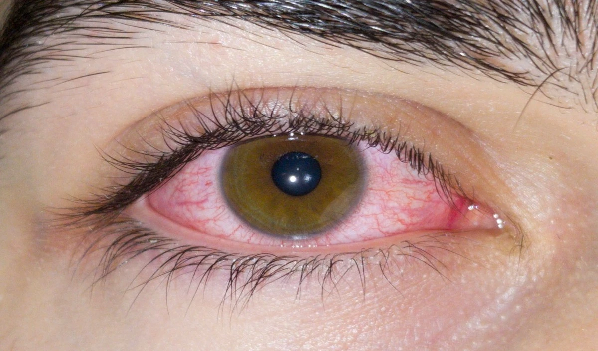 Common Eye Problems