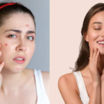 ब्रेकआउट से लेकर चमक तक: एक 3 महीने की स्किनकेयर योजना जो आपकी त्वचा को स्वाभाविक रूप से बदल देती है