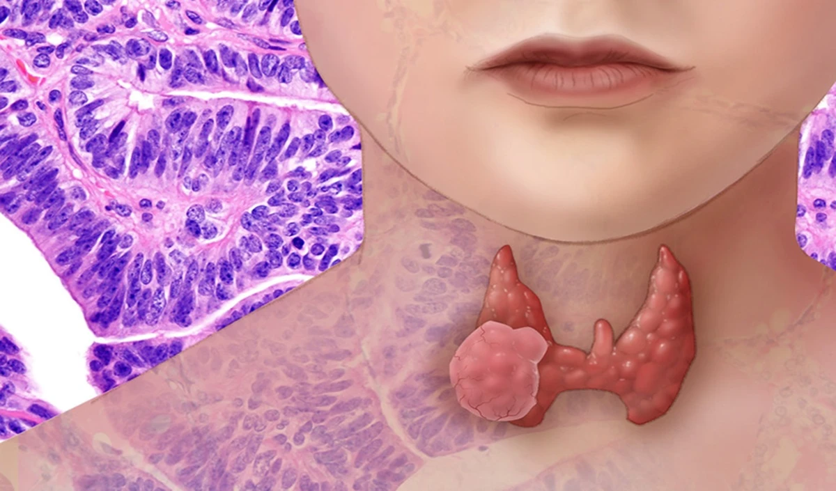 Thyroid Cancer