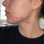 Jawline Acne